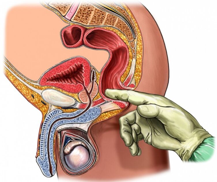 massage de la prostate pour la prostatite