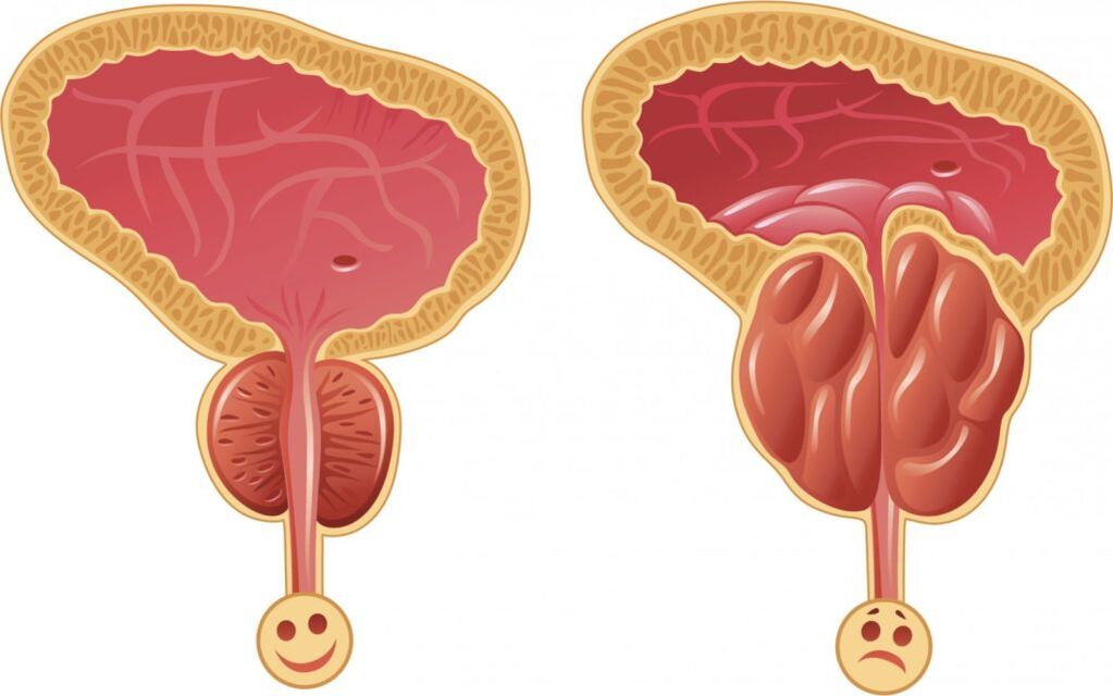 symptômes de la prostatite chez les hommes